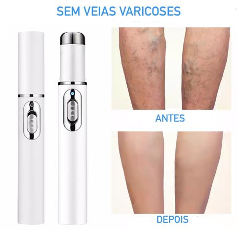 Blue Light Therapy Acne Scar Removal and Varicose Veins 