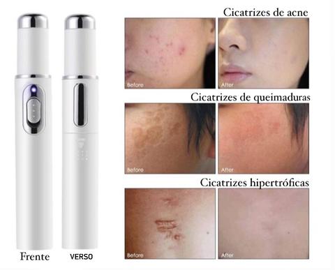 Blue Light Therapy Acne Scar Removal and Varicose Veins 
