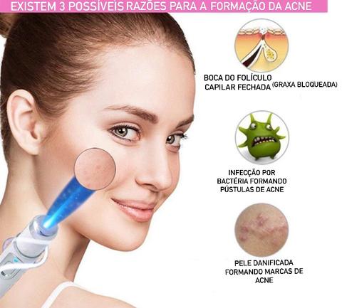 Blue Light Therapy Acne Scar Removal and Varicose Veins 