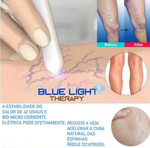 Blue Light Therapy Acne Scar Removal and Varicose Veins 