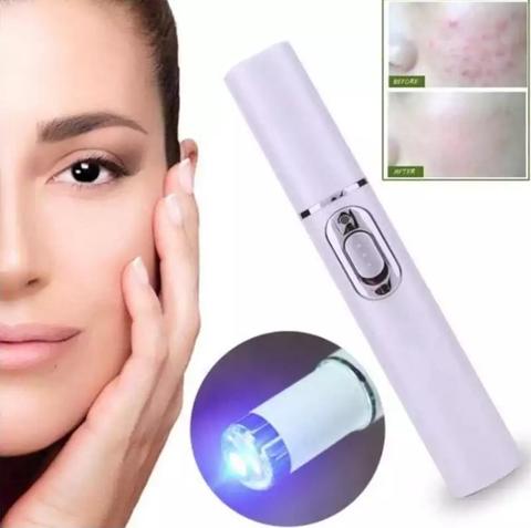 Blue Light Therapy Acne Scar Removal and Varicose Veins 